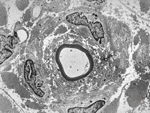 F,23y. | - n.suralis- hypertrophic demyelinizing neuropathy (onion bulbs)